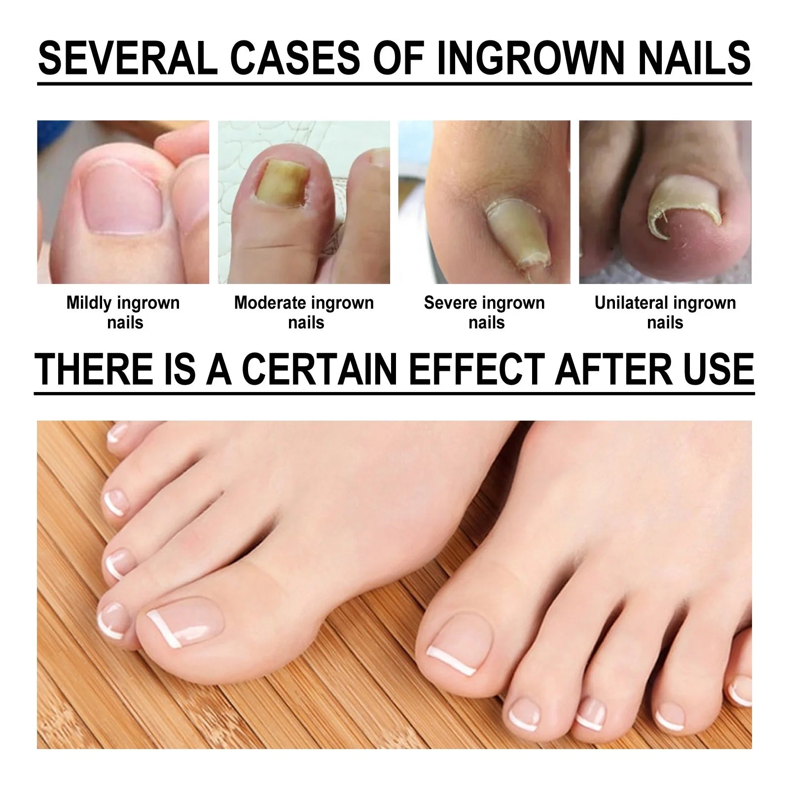 NailDrops® | 87% Experienced Relief From Ingrown Toenail Pain in Just 7 Days