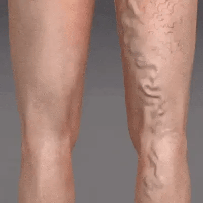 Natural Varicose Vein Spray – Feel Confident Again in Just 1 Week