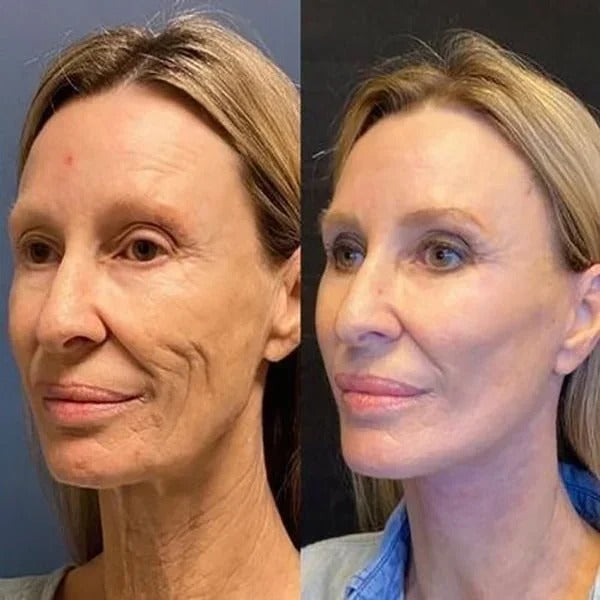 SkinLift | 7 Day Visible Botox Face Serum