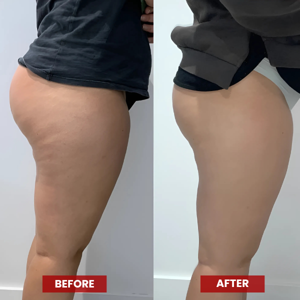 E-GuaSha | 96% Saw Firmer, Smoother, Cellulite-Free Skin After Just 1 Session!