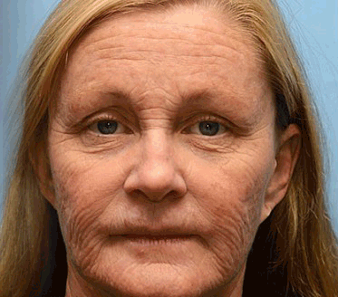 Botox Wrinkle Removal Cream – Look 10 Years Younger in Just Weeks!