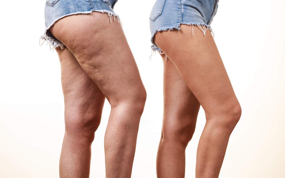 E-GuaSha | 96% Saw Firmer, Smoother, Cellulite-Free Skin After Just 1 Session!
