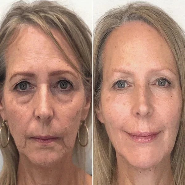 SkinLift | 7 Day Visible Botox Face Serum