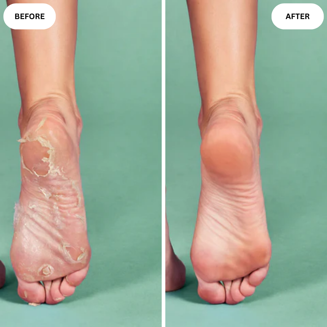Korean Foot Peel Mask | Baby-Soft Feet in 10 minutes